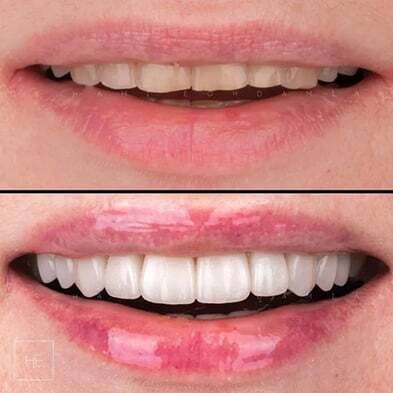 Smile transformation - dental veneers result