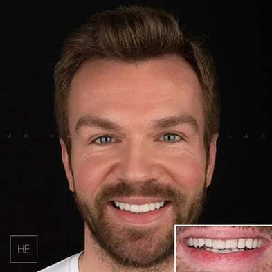 Teeth whitening transformation