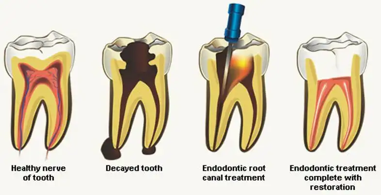 root-canal-steps