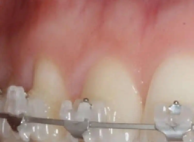 smart-wire-orthdontics-marbella