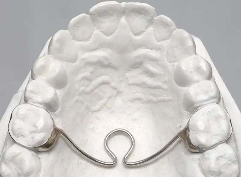 space-maintainer-orthodontics-1