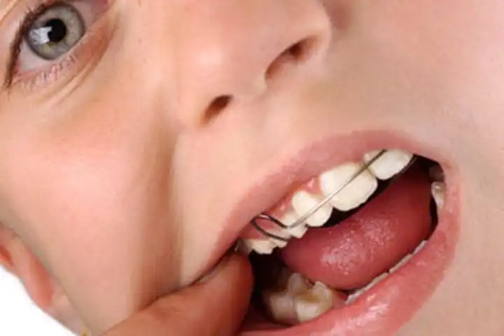 teeth-retainer