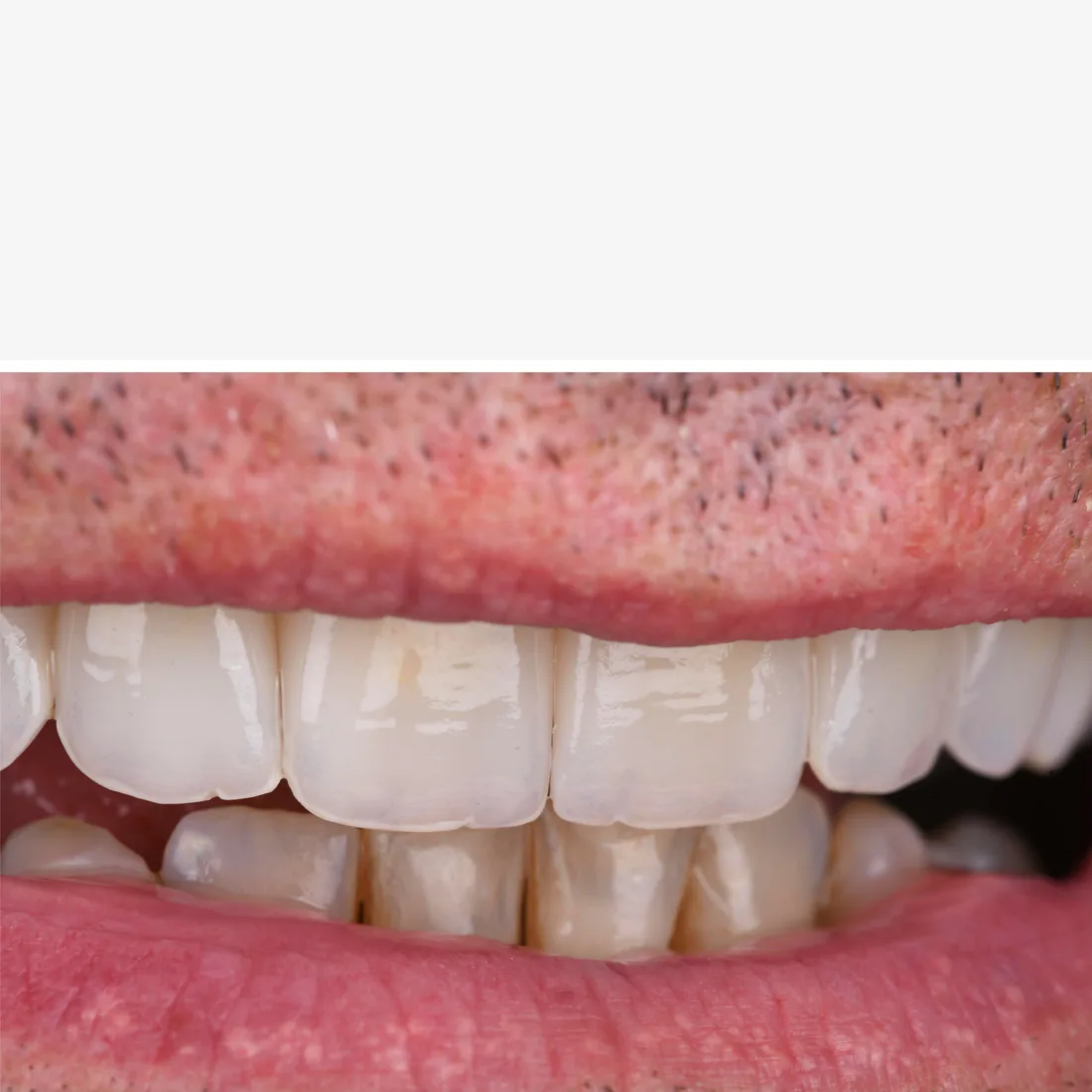 Close-up of natural-looking porcelain veneers