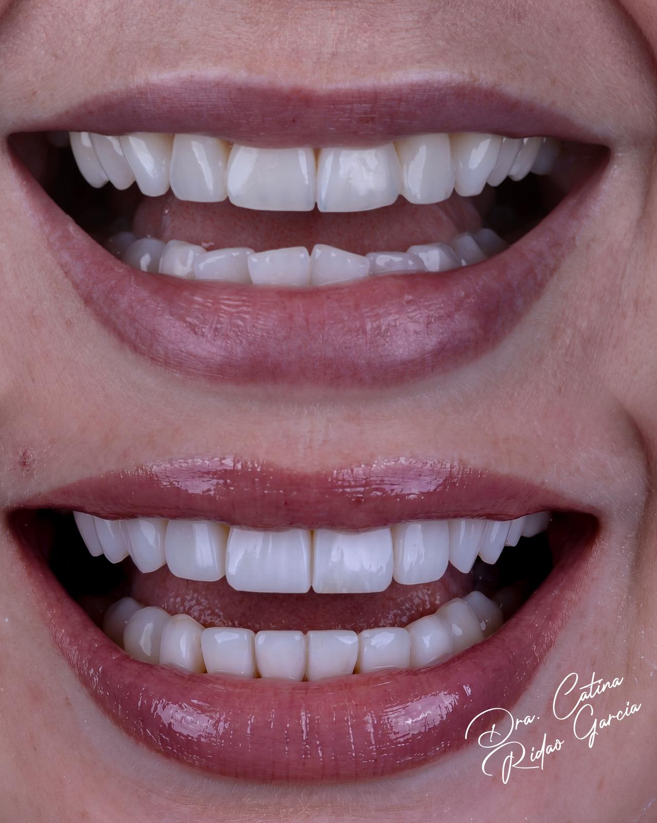 Carillas de composite naturales: antes y después Carillas de composite naturales Marbella antes y después de la sonrisa