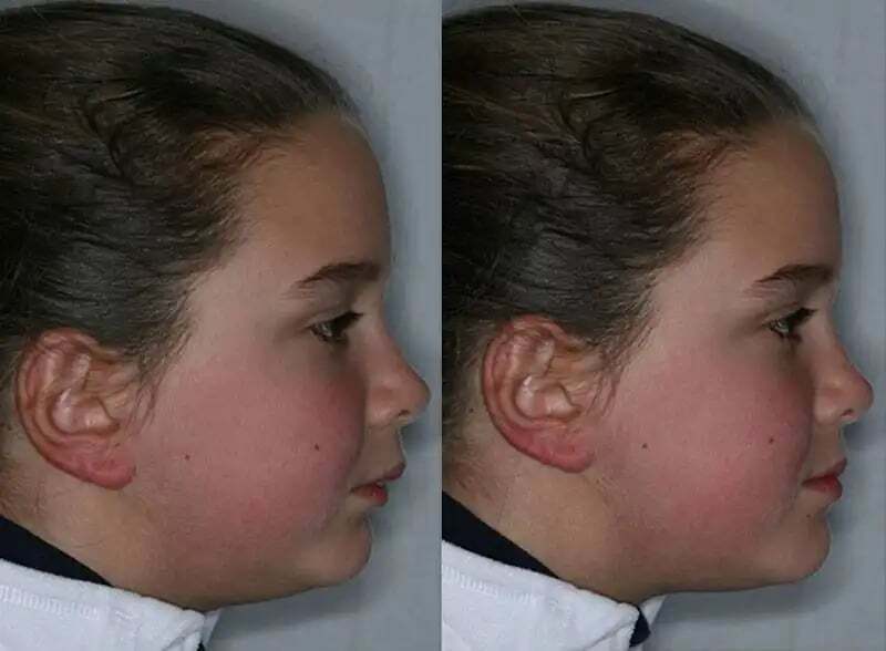 Registros del perfil facial