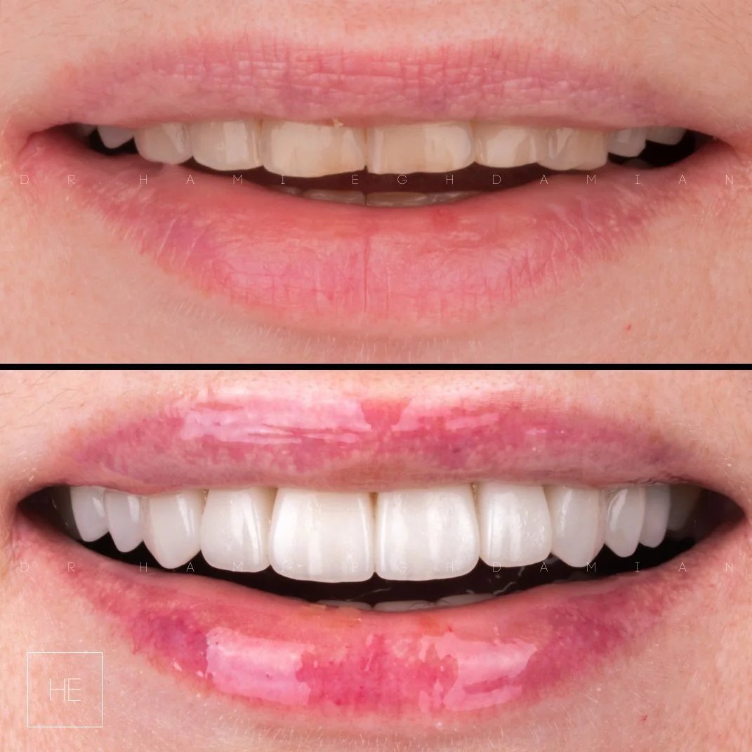 dental veneers in Marbella before and after smile