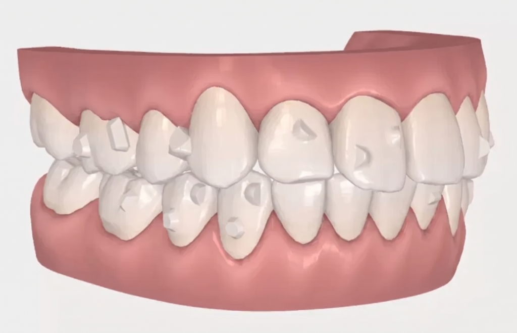 Illustration showing attachment shapes and positions on upper and lower teeth
