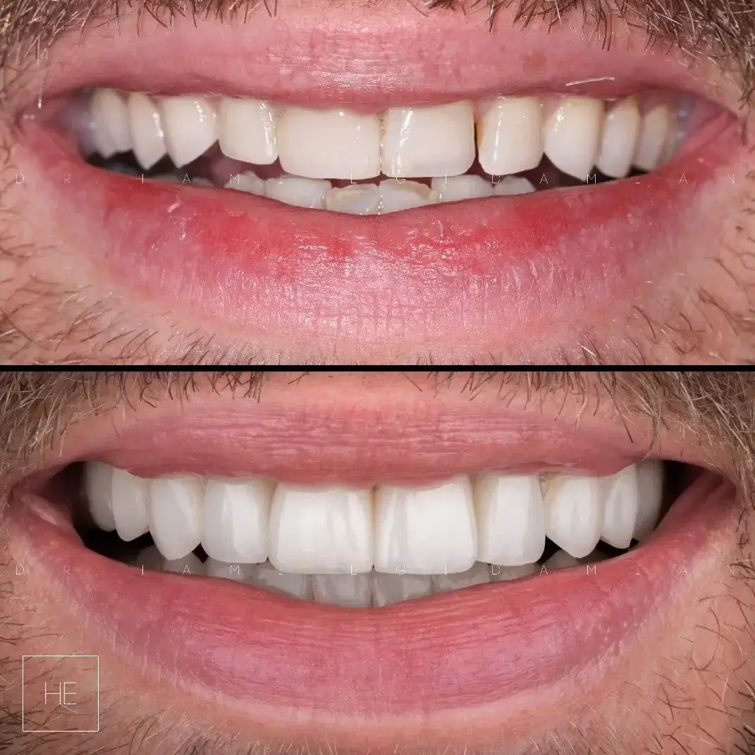 smile-transformation-veneers-Marbella