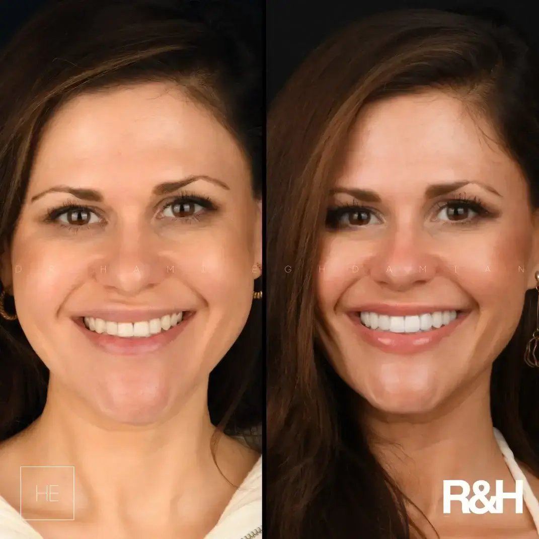 smile-transformation-marbella-all on 6