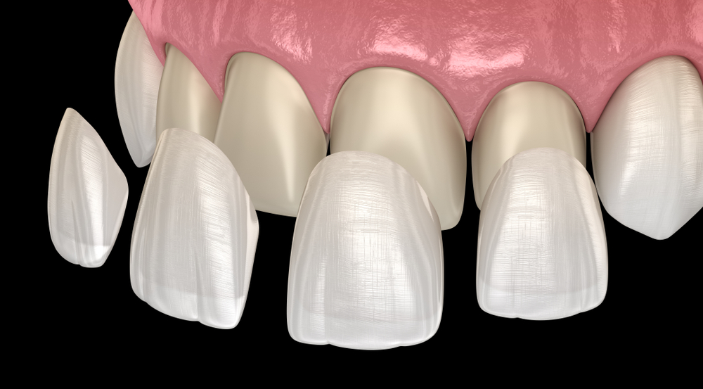 Ilustración de carillas separadas de la superficie anterior de los dientes