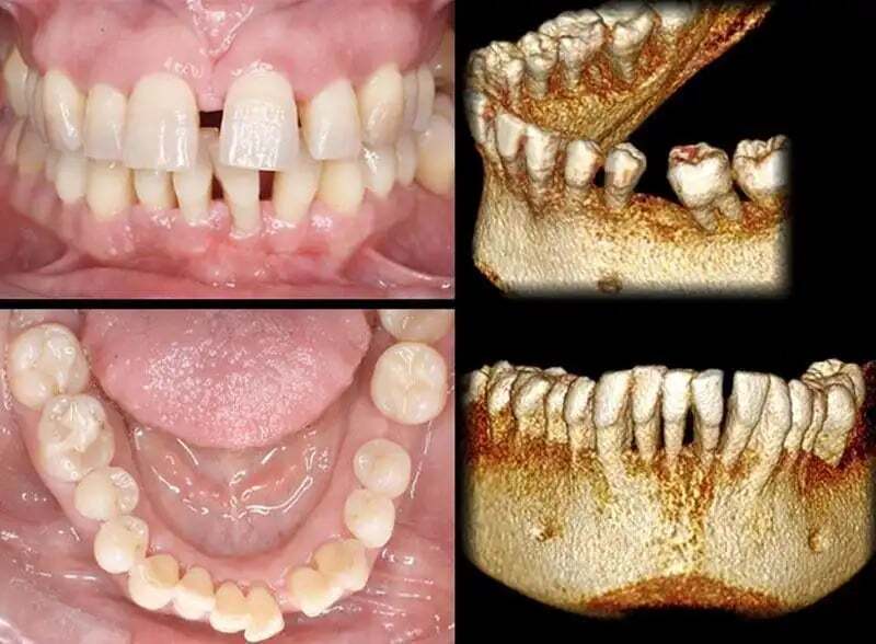 Dientes y hueso de soporte
