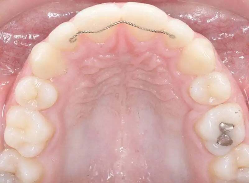 Retenedor fijo en la cara interna de los dientes superiores