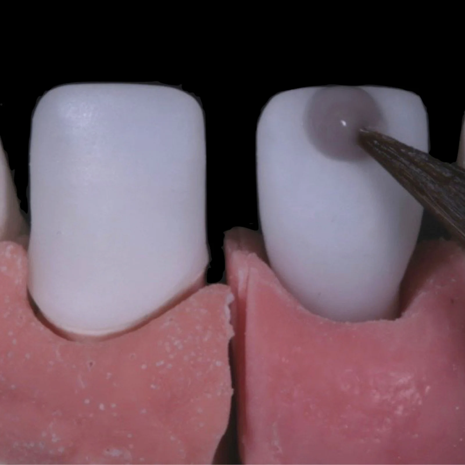 Close-up of ceramic veneer craftsmanship at R&H Dental