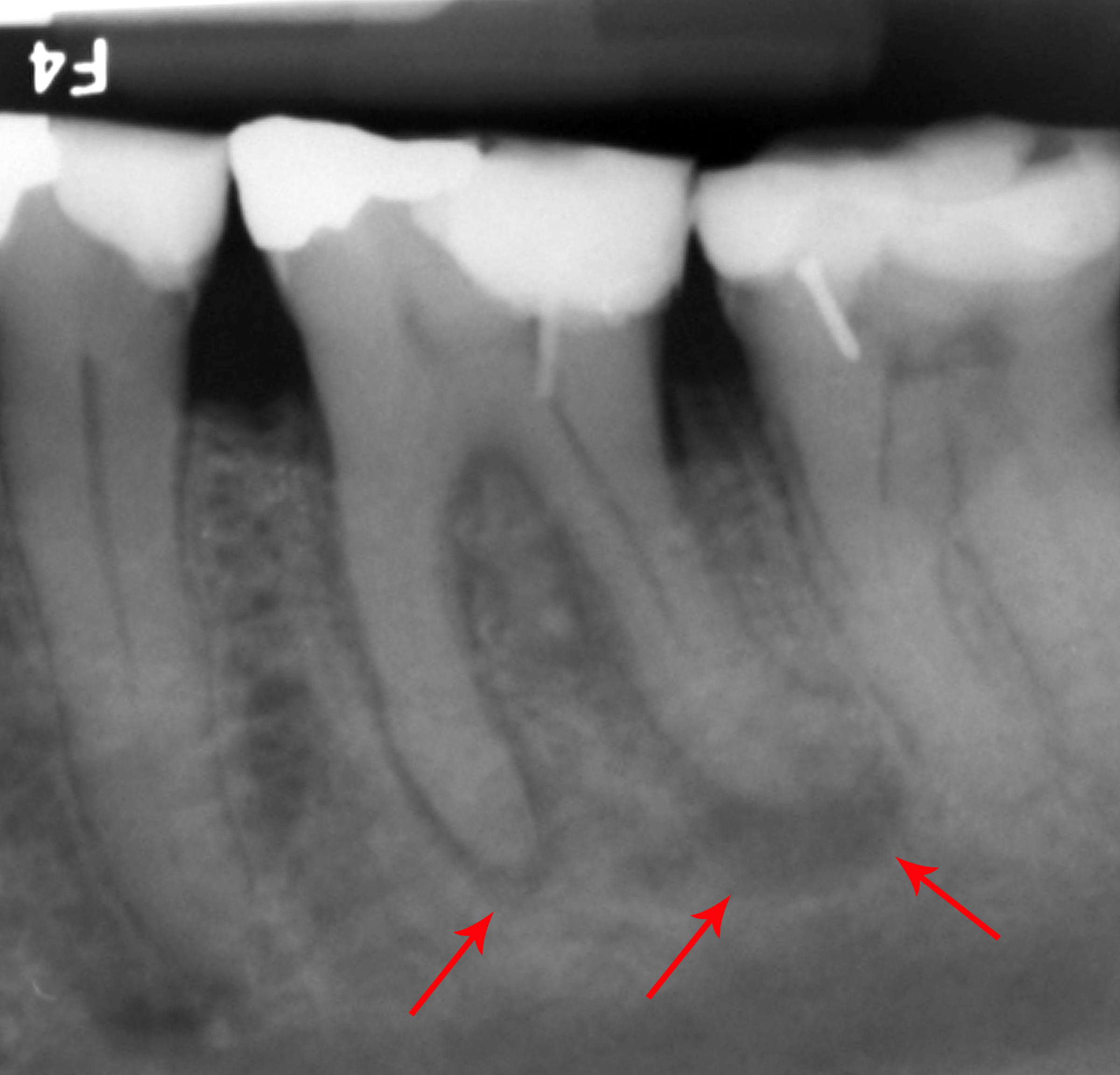 Radiografía intraoral · periapical
