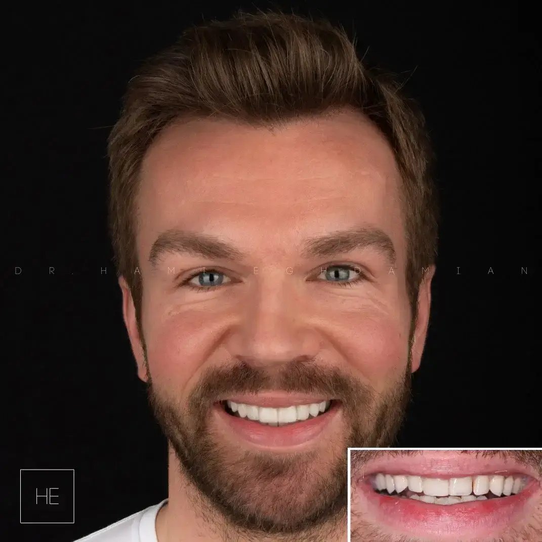 porcelain veneers Marbella close-up result