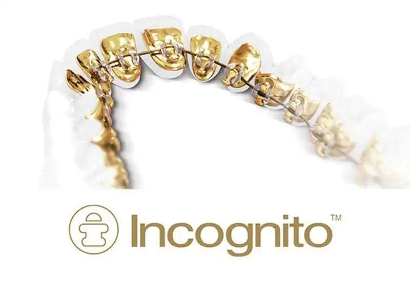 Brackets linguales