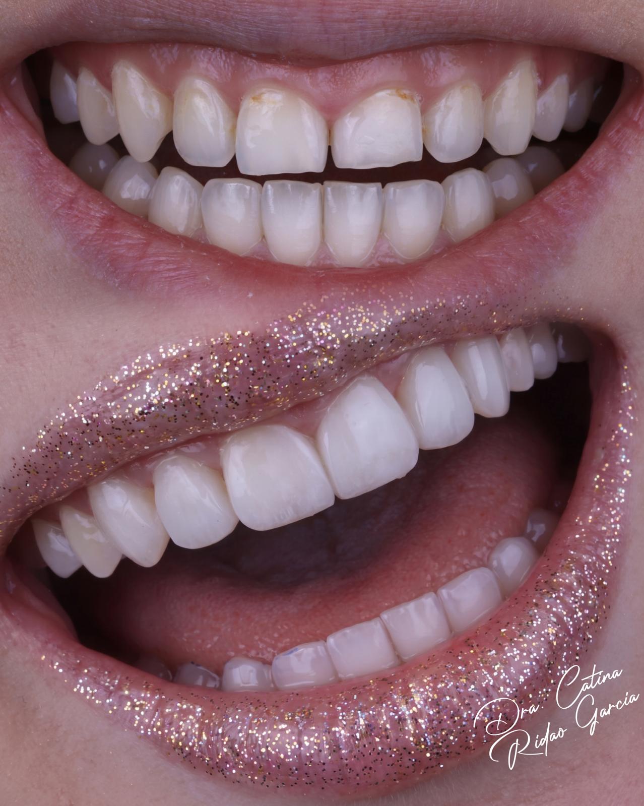 Carillas de composite: antes y después Carillas de composite Marbella antes y después con resultado de sonrisa natural