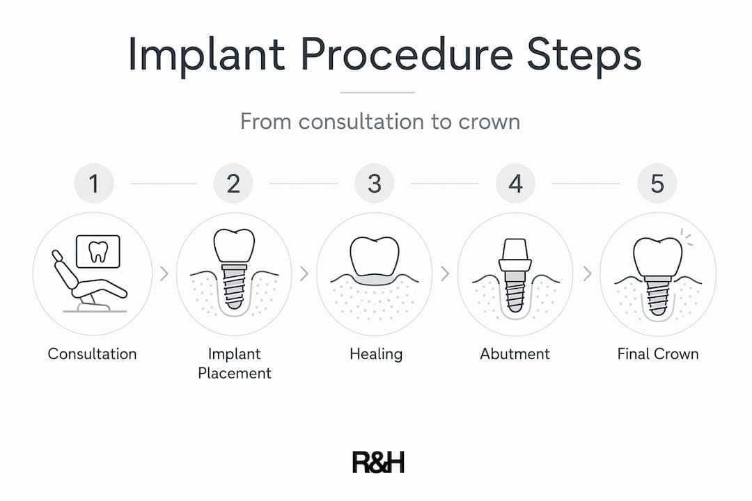 Infographic visualizing implant procedure steps