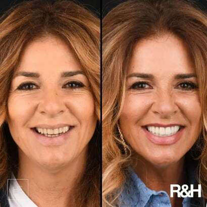 all-on-6 Marbella fixed teeth before and after
