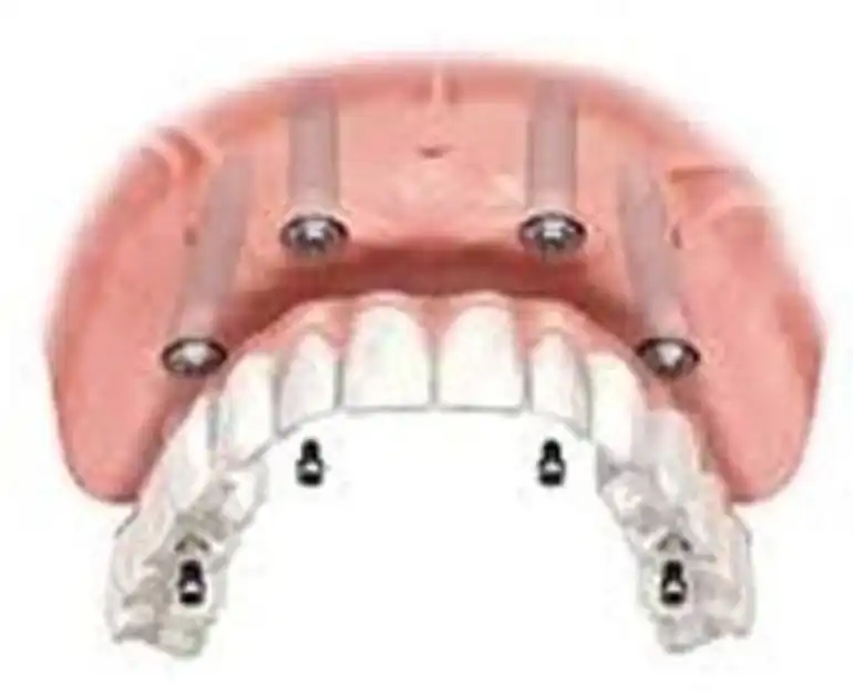 all-on-4 Marbella full arch smile result