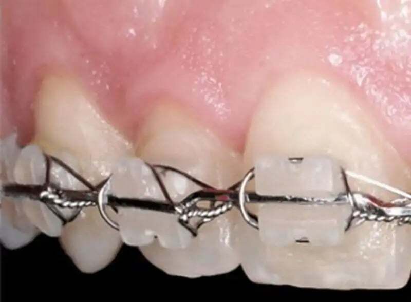 Brackets convencionales