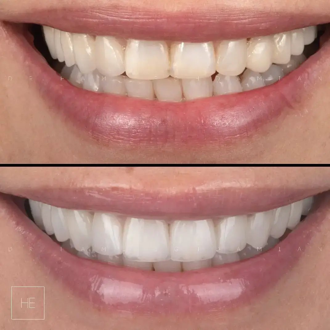 veneer smile design at dental veneers Marbella clinic