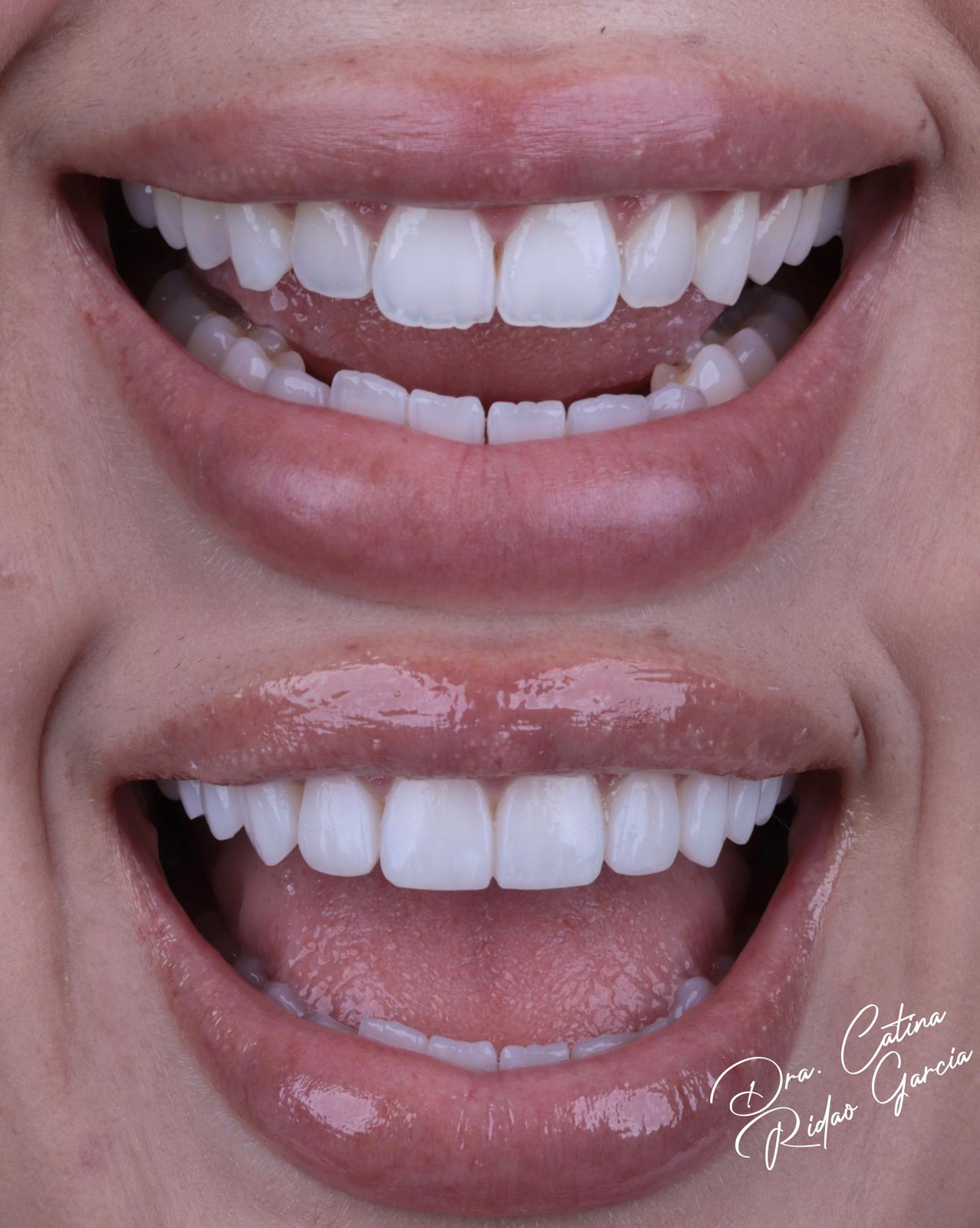 Carillas de composite en dientes anteriores Carillas de composite Marbella antes y después en dientes delanteros
