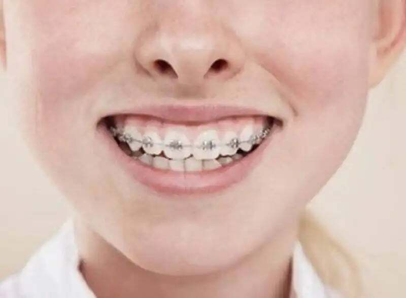 Brackets superiores