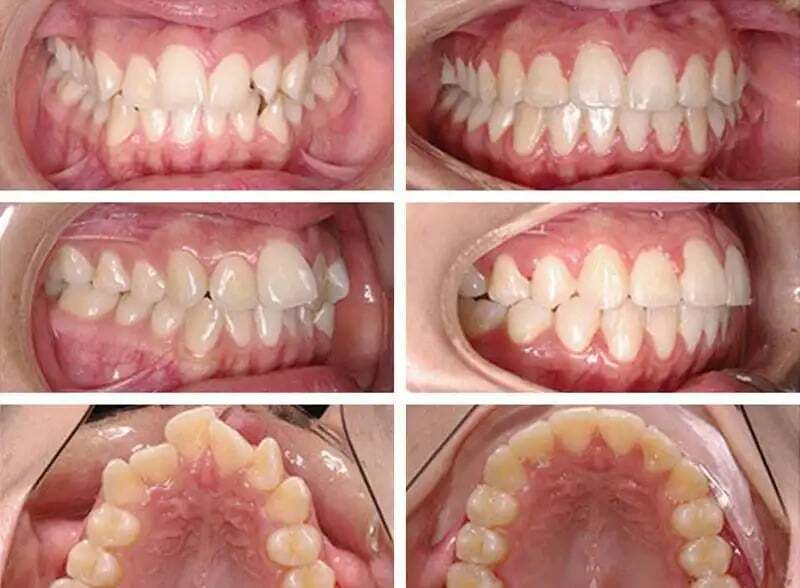 Bite and tooth position
